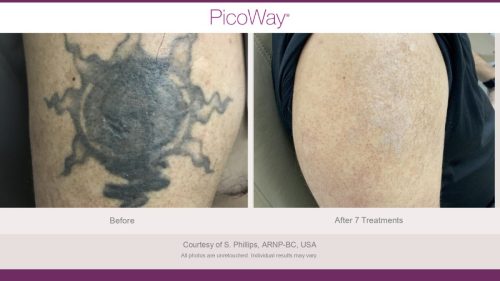 PicoWay HCP Before and After Photos Library (1)_page-0002