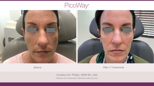 PicoWay HCP Before and After Photos Library (1)_page-0003