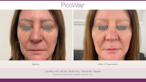 PicoWay HCP Before and After Photos Library (1)_page-0004