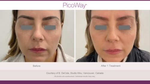 PicoWay HCP Before and After Photos Library (1)_page-0005