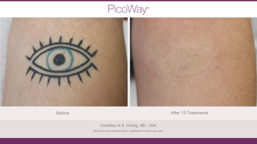 PicoWay HCP Before and After Photos Library (1)_page-0006