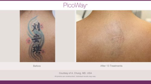 PicoWay HCP Before and After Photos Library (1)_page-0007