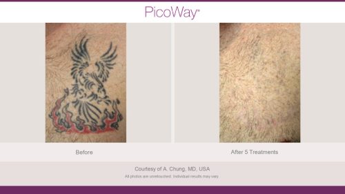 PicoWay HCP Before and After Photos Library (1)_page-0008