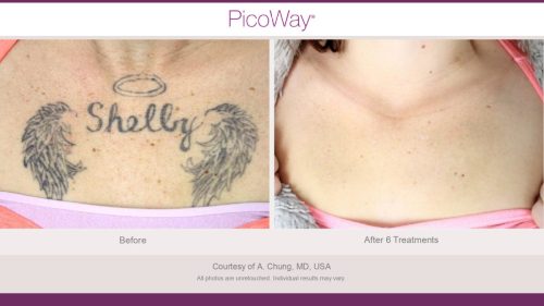 PicoWay HCP Before and After Photos Library (1)_page-0009