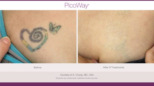PicoWay HCP Before and After Photos Library (1)_page-0010