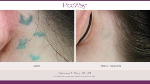 PicoWay HCP Before and After Photos Library (1)_page-0011