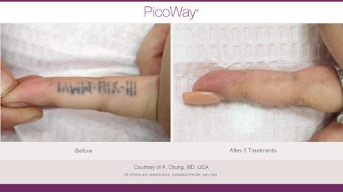 PicoWay HCP Before and After Photos Library (1)_page-0012