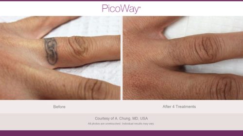 PicoWay HCP Before and After Photos Library (1)_page-0013