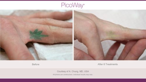 PicoWay HCP Before and After Photos Library (1)_page-0014