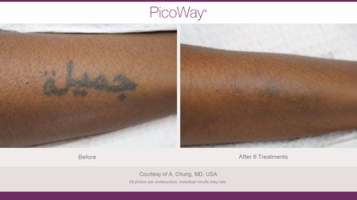 PicoWay HCP Before and After Photos Library (1)_page-0015