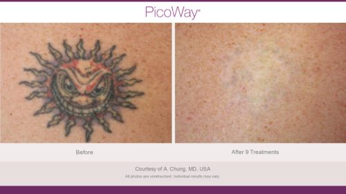 PicoWay HCP Before and After Photos Library (1)_page-0016