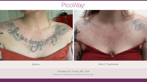 PicoWay HCP Before and After Photos Library (1)_page-0017