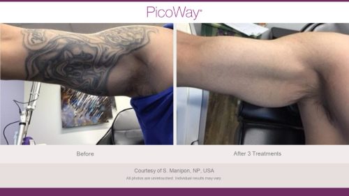 PicoWay HCP Before and After Photos Library (1)_page-0018