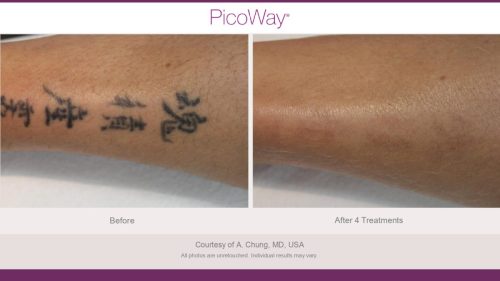 PicoWay HCP Before and After Photos Library (1)_page-0020