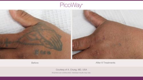 PicoWay HCP Before and After Photos Library (1)_page-0022