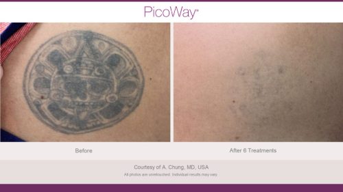 PicoWay HCP Before and After Photos Library (1)_page-0023