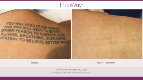 PicoWay HCP Before and After Photos Library (1)_page-0024