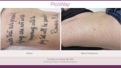 PicoWay HCP Before and After Photos Library (1)_page-0025