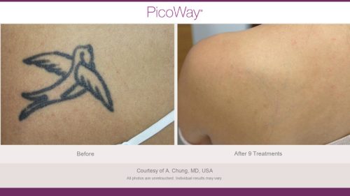 PicoWay HCP Before and After Photos Library (1)_page-0026