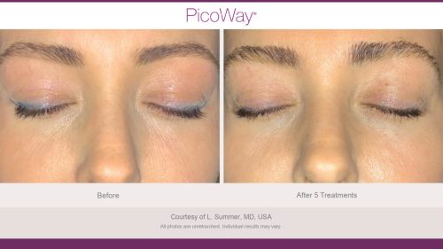 PicoWay HCP Before and After Photos Library (1)_page-0027