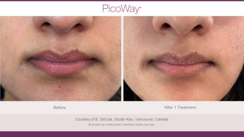 PicoWay HCP Before and After Photos Library (1)_page-0028