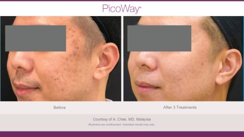 PicoWay HCP Before and After Photos Library (1)_page-0031