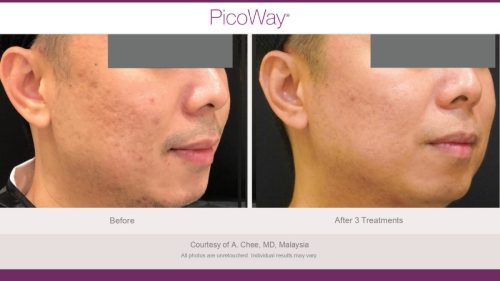 PicoWay HCP Before and After Photos Library (1)_page-0032