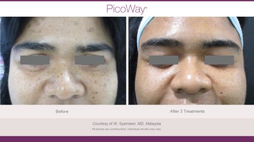 PicoWay HCP Before and After Photos Library (1)_page-0033