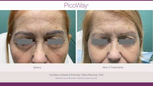 PicoWay HCP Before and After Photos Library (1)_page-0034