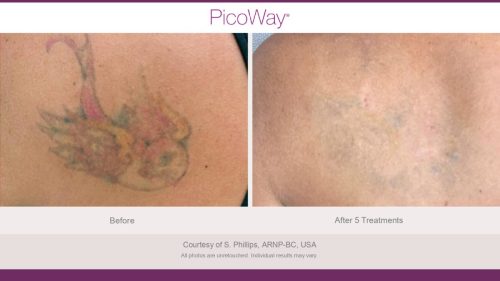 PicoWay HCP Before and After Photos Library (1)_page-0036
