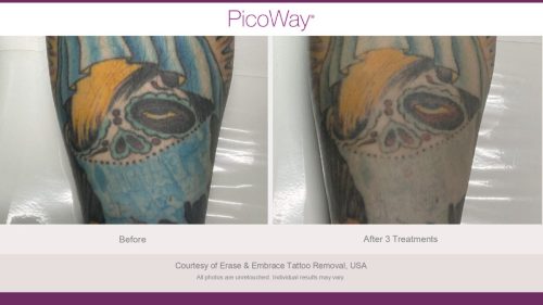 PicoWay HCP Before and After Photos Library (1)_page-0038